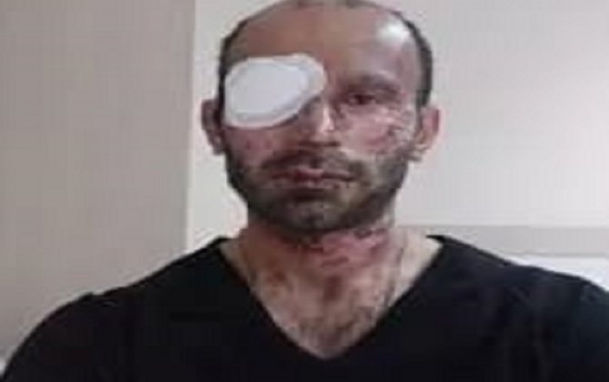 “Masallı İcra Hakimiyyətindən bir dəfə də qapımı açmayıblar”-Vətən müharibəsində gözünü itirən qazidən şok sözlər 2 image-22222