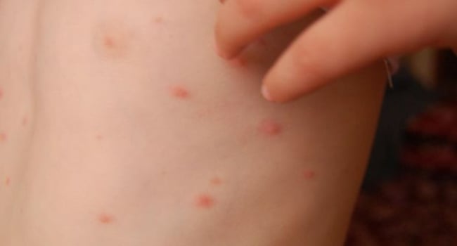 Avropada təhlükəli “supergöbələk” sürətlə yayılır 1 image-80